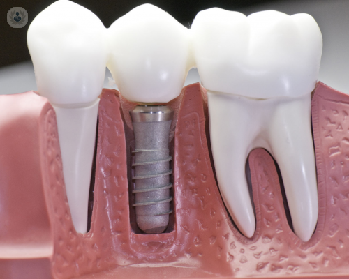implantes-dentales
