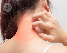 mujer-con-eczema