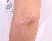 psoriasis-en-la-piel