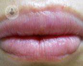 queiloplastia