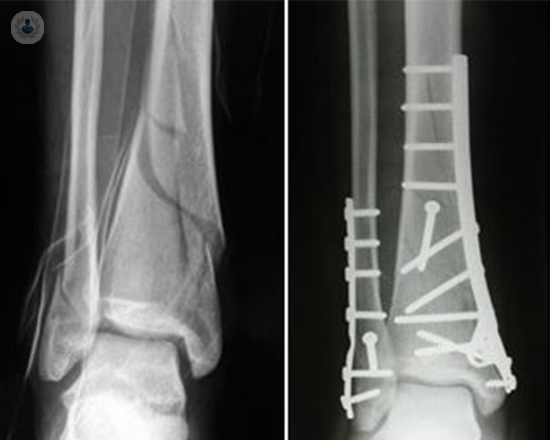 fracturas