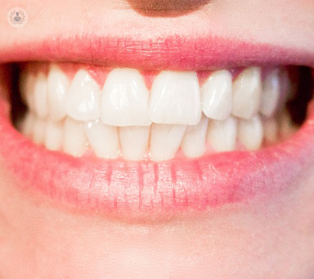 sonrisa-perfecta