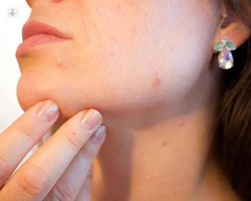 tratamiento-acne