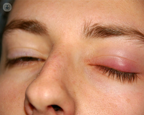 ptosis-cirugia