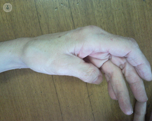 rizartrosis
