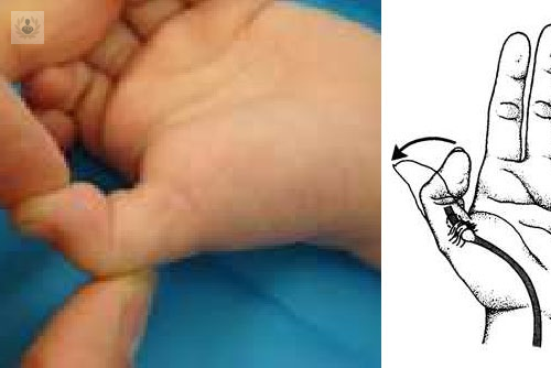 pulgar-pulgar-en-resorte-mano-dedo-traumatologia-infantil