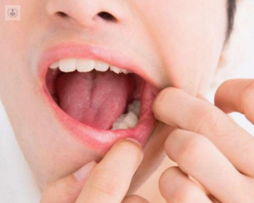 candidiasis-tratamiento-casero