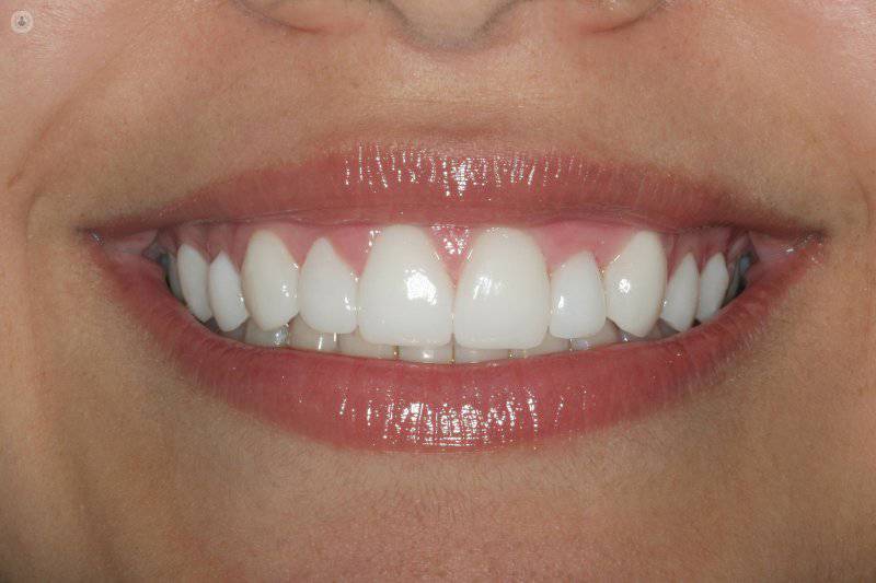 Carillas dentales sin limar el diente