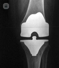 La protesis de rodilla es cada vez más segura por los avances