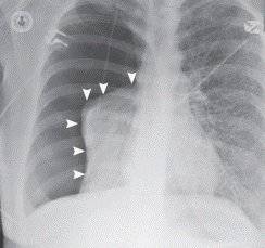 Neumotorax, una presencia de aire en la cavidad pleural