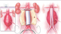 aneurisma de aorta