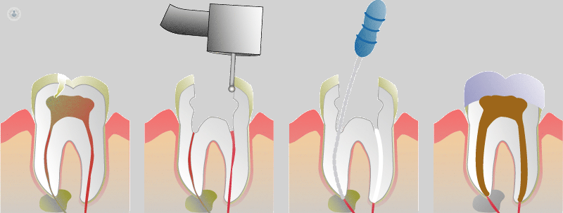 Endodoncia