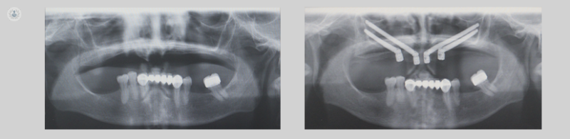 implantes cigomaticos