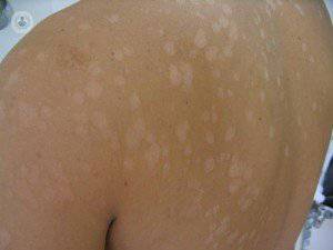 Hongos, una causa de manchas blancas la piel | Top Doctors