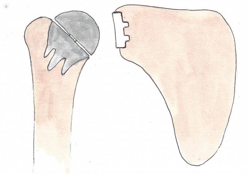 Protesis de hombro total sin vastago