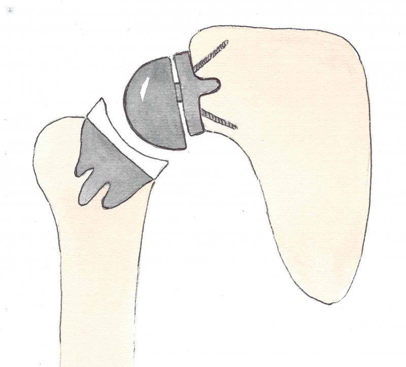 Protesis de hombro invertida sin vástago