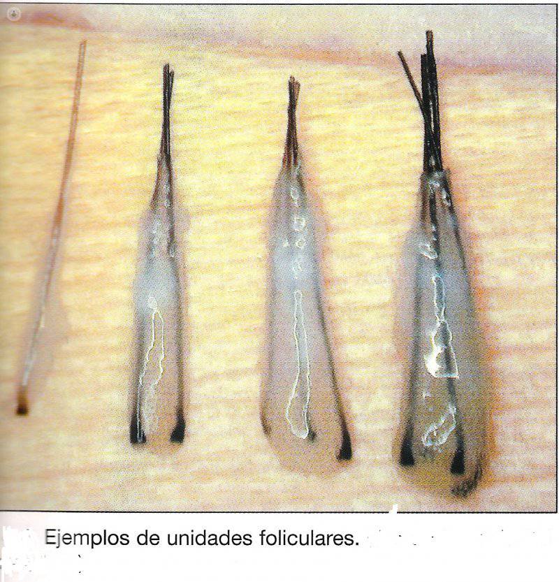 Unidades foliculares