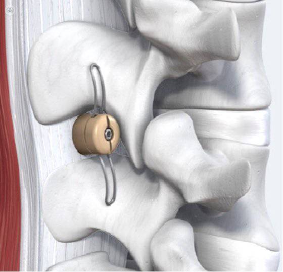 estenosis lumbar