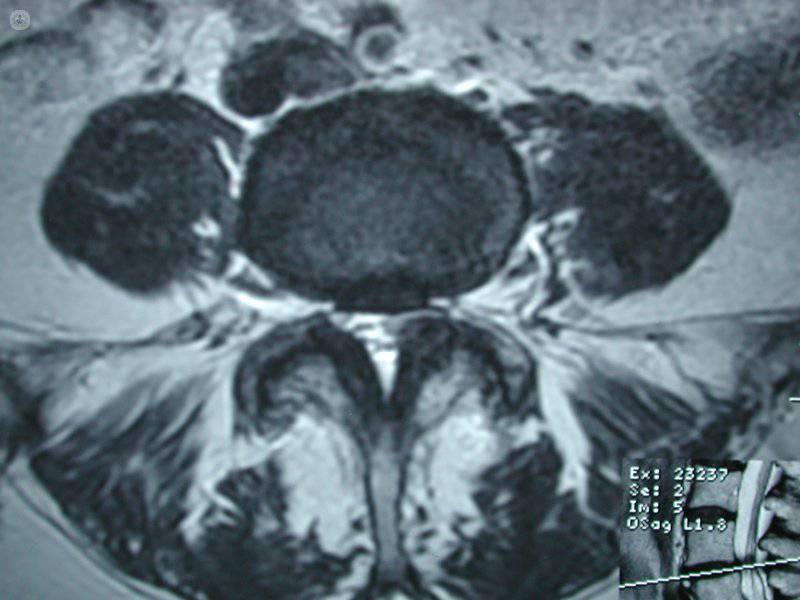 estenosis de canal lumbar