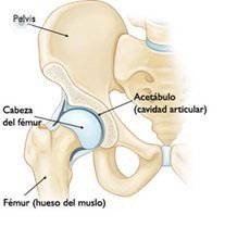 protesis de cadera