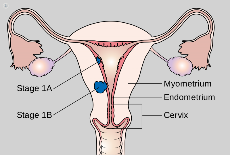 cancer de utero