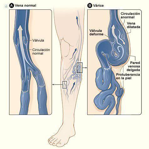 varices