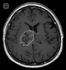 tumor cerebral glioblastoma