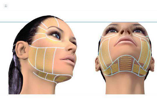 lifting facial no invasivo
