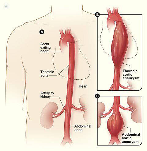aneurisma de aorta cuerpo