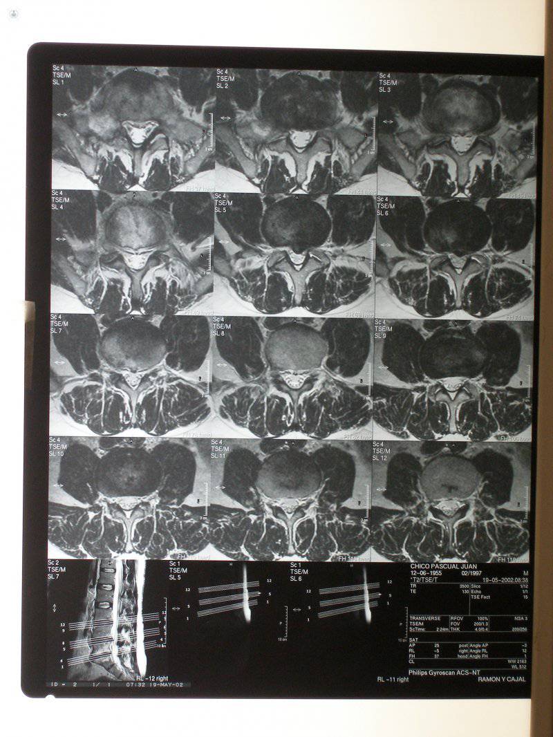 radiologia lumbago 