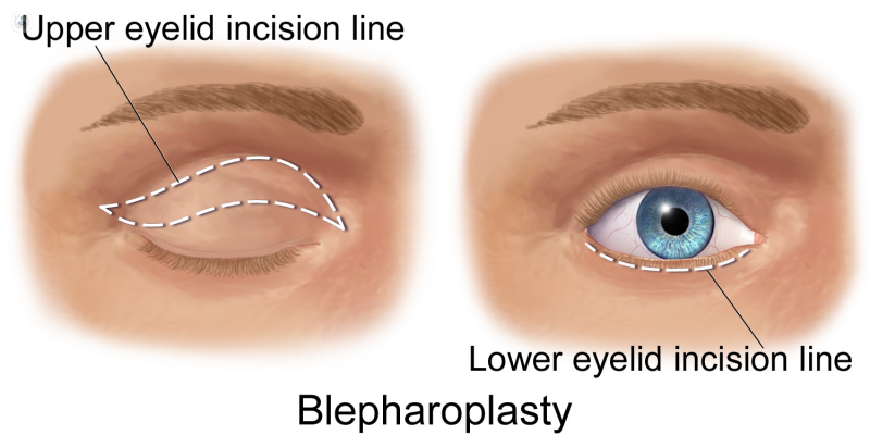 blefaroplastia