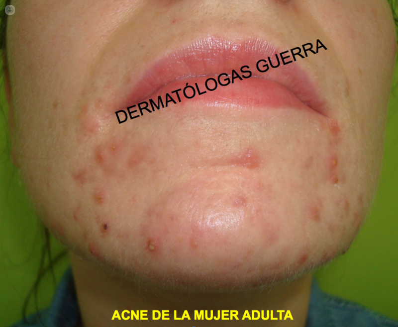 foto acne mujer