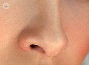 septorrinoplastia cirugia nariz