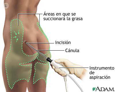 liposuccion explicacion