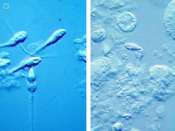 biopsia testicular tambre