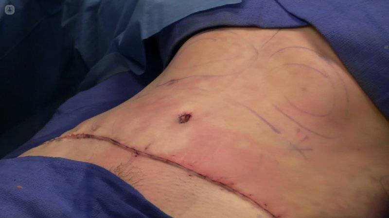Cirugía de la pared abdominal – Cirugía Balsells