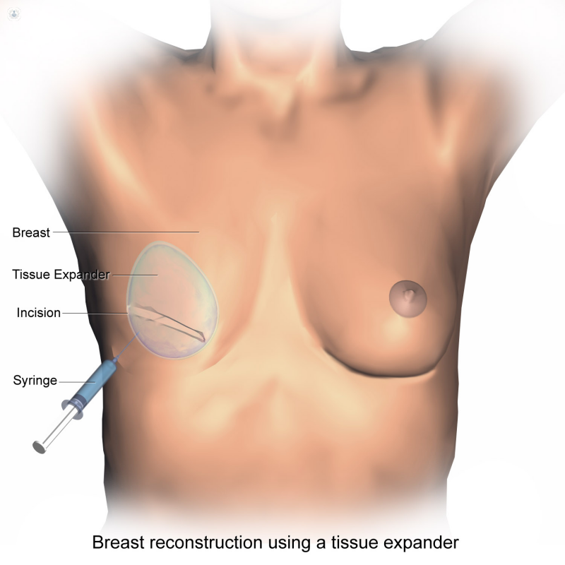Reconstrucción mamaria procedimiento tras el cáncer de mama