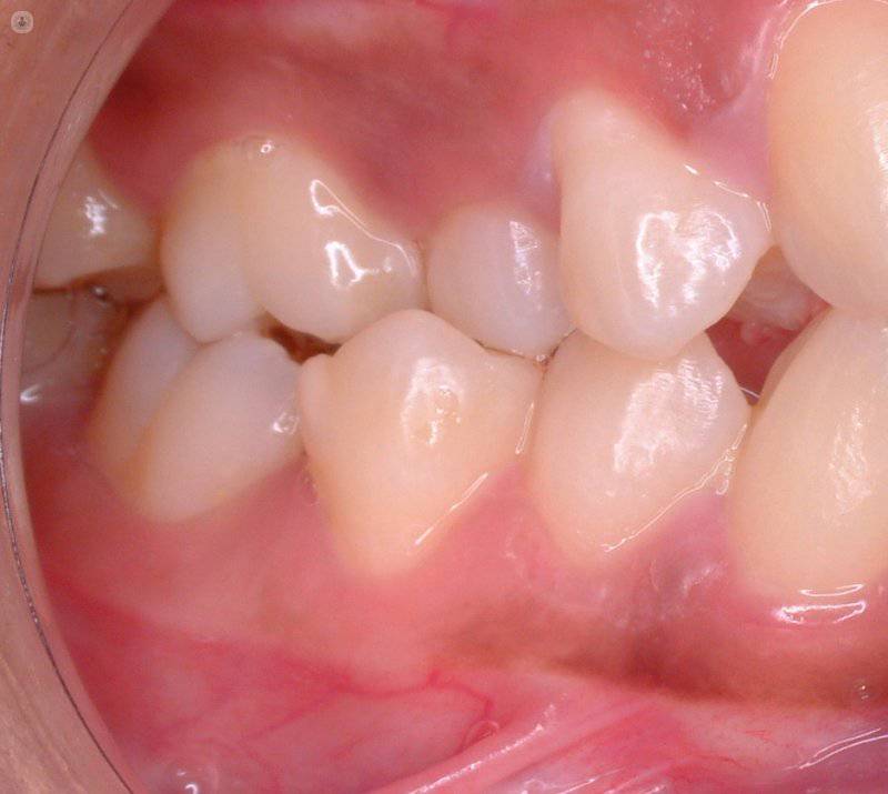 problemas de mandibula