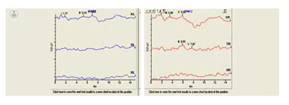 grafico peatc hipoacusia