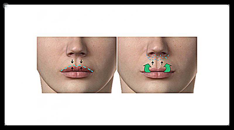 intervencion labio superior