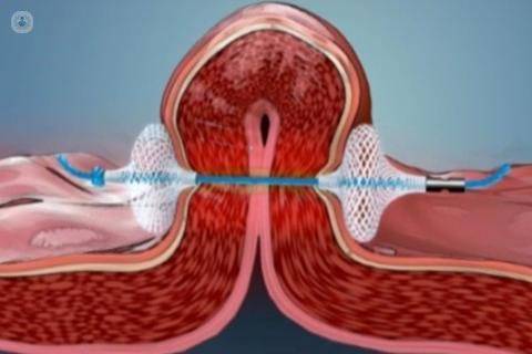 método pose de endoscopia obesidad