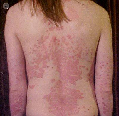 psoriasis niños