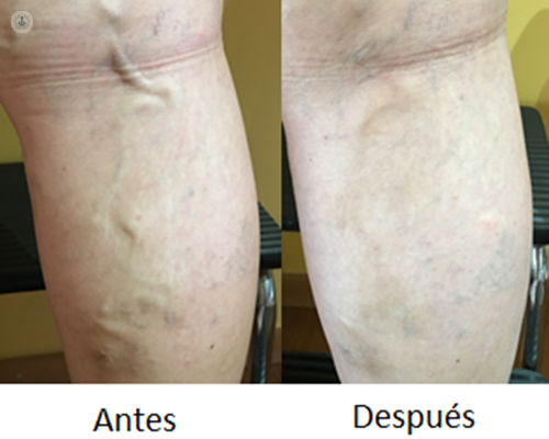 resultados esclerosis con espuma