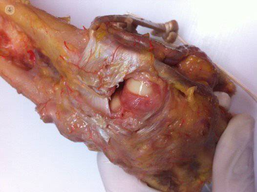 lesión del ligamento escafosemilunar