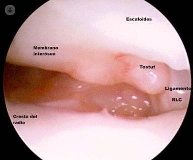 tratamiento de la rotura de ligamento