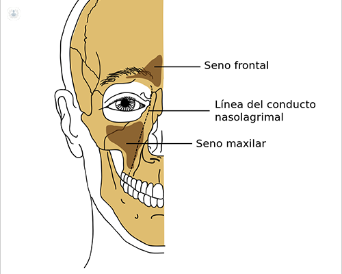 elevación de seno maxilar