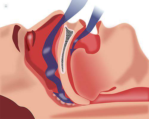 cirugía de apnea del sueño