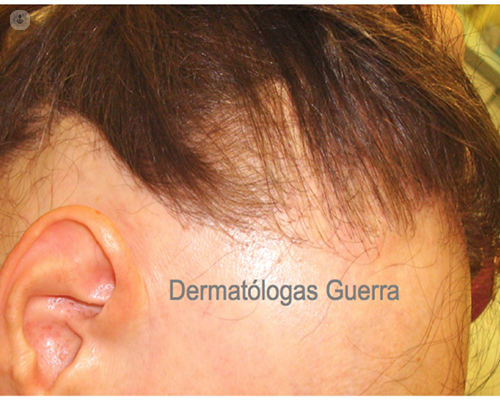 alopecia frontal fibrosante