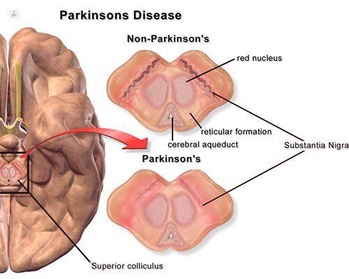 imagen parkinson