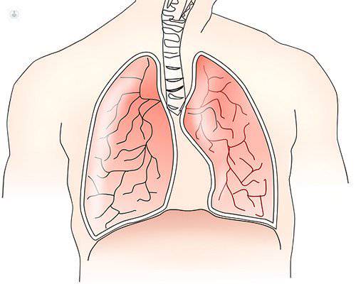 nódulos en los pulmones